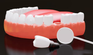 A dental implant to replace missing tooth.